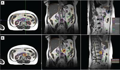 Case report: Intrafraction dose-guided tracking for gastrointestinal organ-at-risk isotoxicity delivery on an MR-guided radiotherapy system